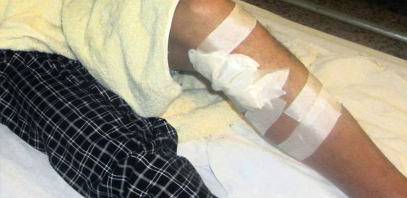 herido-bala-piernajpg